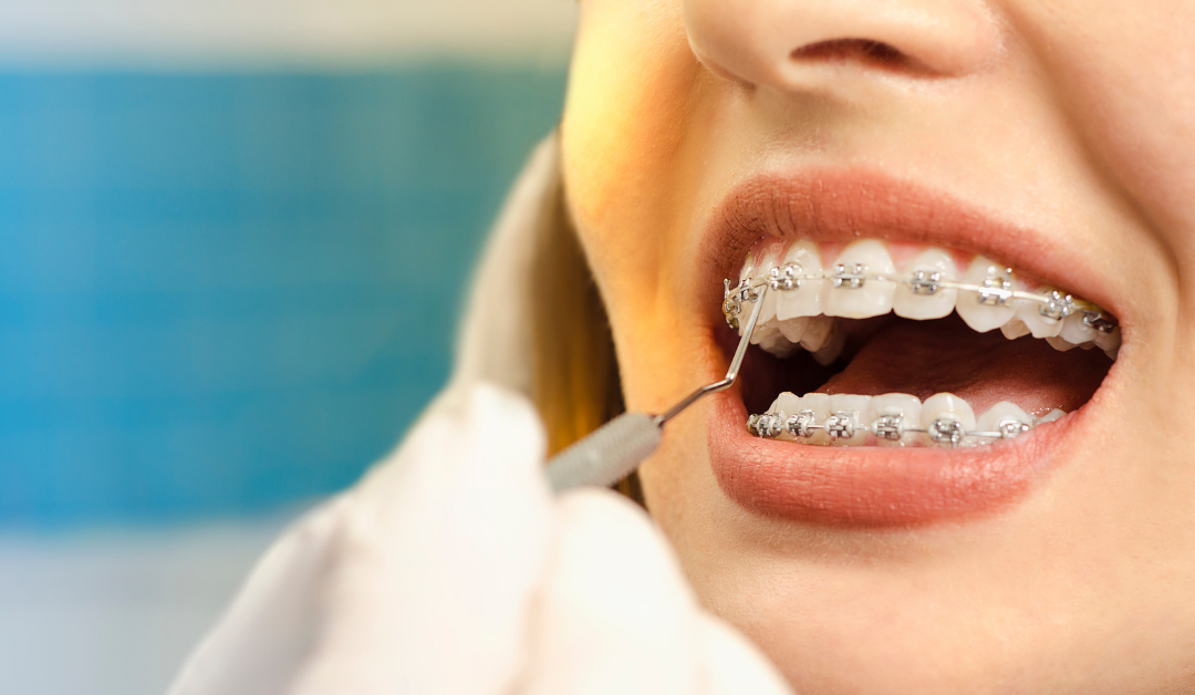 The Most Frequently Asked Questions About Braces, Answered